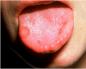 الأمراض الالتهابية في تجويف الفم والبلعوم يسبب التهاب الغشاء المخاطي للفم