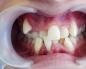 What type of prosthesis should be used to replace one or more teeth in the mouth?
